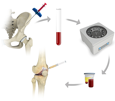 Bone Marrow Aspirate Concentrate (BMAC) Treatment