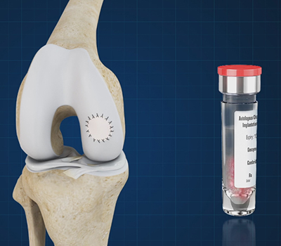Matrix Induced Autologous Chondrocyte Implantation (MACI)
