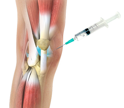 Hyaluronan preparation into the joint