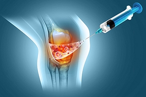 Is Viscosupplementation a Better Alternative to Cortisone Injections in Boca Raton, Boynto...